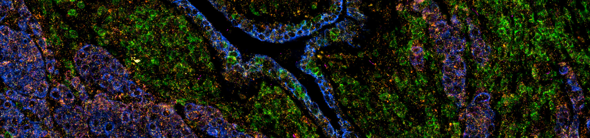 Human breast cancer, FFPE tissue