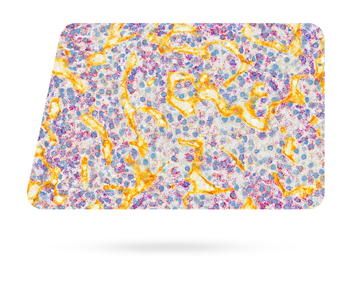 RNAscope VS Universal HRP kit, Liver cancer, CD31, PPIB