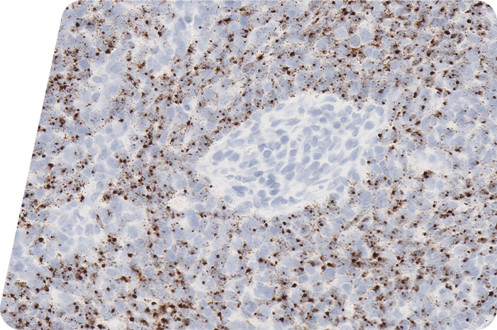 HPV Positive F00118953 